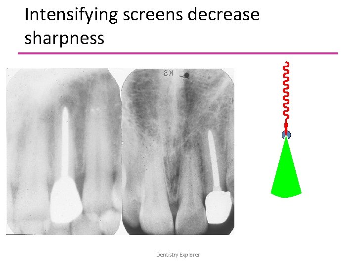 Intensifying screens decrease sharpness Dentistry Explorer 