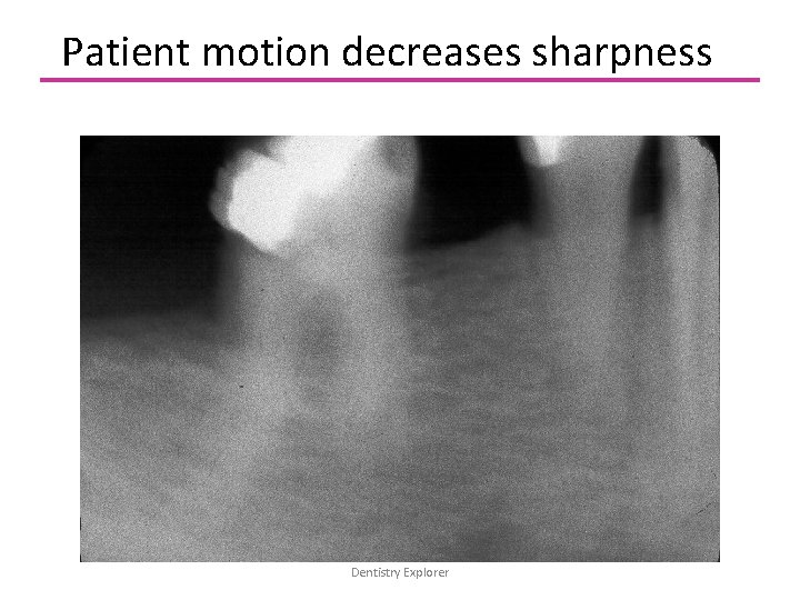 Patient motion decreases sharpness Dentistry Explorer 