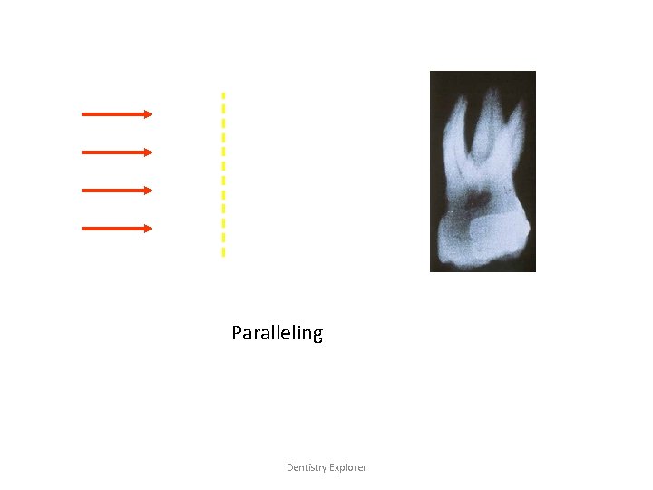 Paralleling Dentistry Explorer 