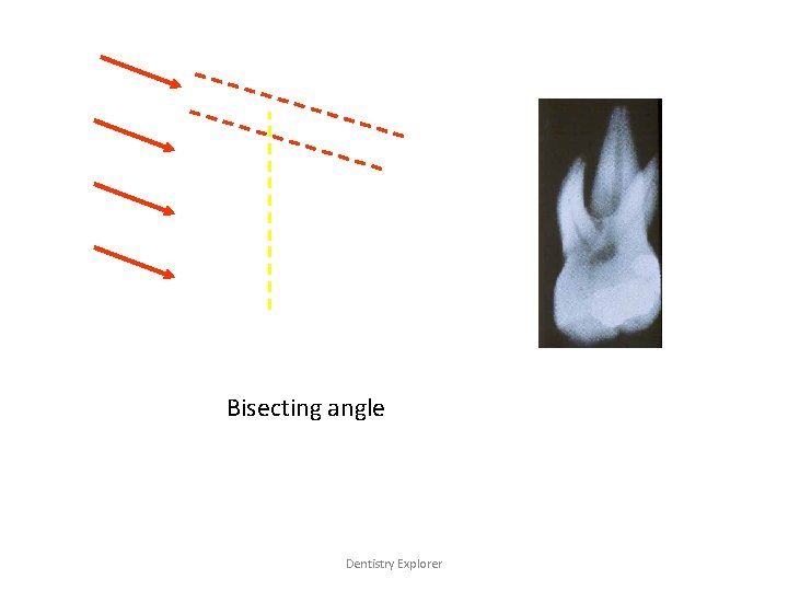 Bisecting angle Dentistry Explorer 