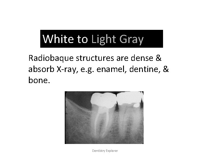 RADIOPAQUE White to Light Gray Radiobaque structures are dense & absorb X-ray, e. g.