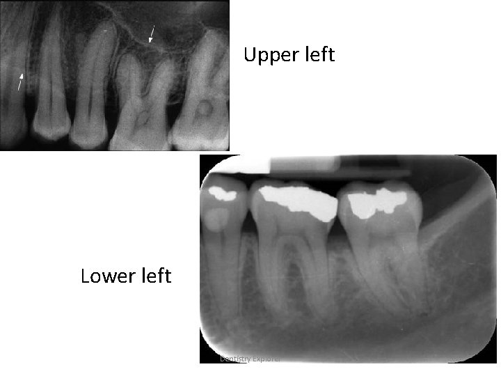 Upper left Lower left Dentistry Explorer 