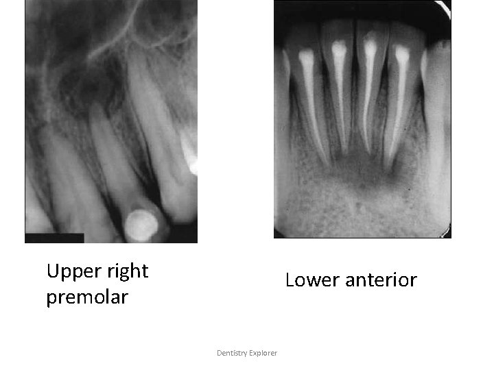 Upper right premolar Lower anterior Dentistry Explorer 