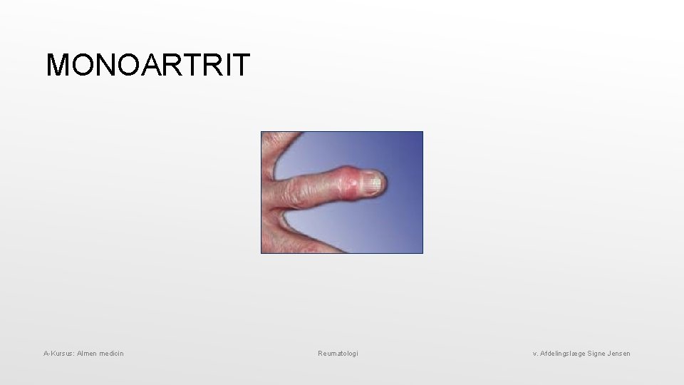 MONOARTRIT A-Kursus: Almen medicin Reumatologi v. Afdelingslæge Signe Jensen 