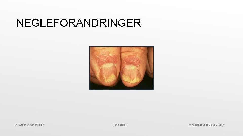 NEGLEFORANDRINGER A-Kursus: Almen medicin Reumatologi v. Afdelingslæge Signe Jensen 