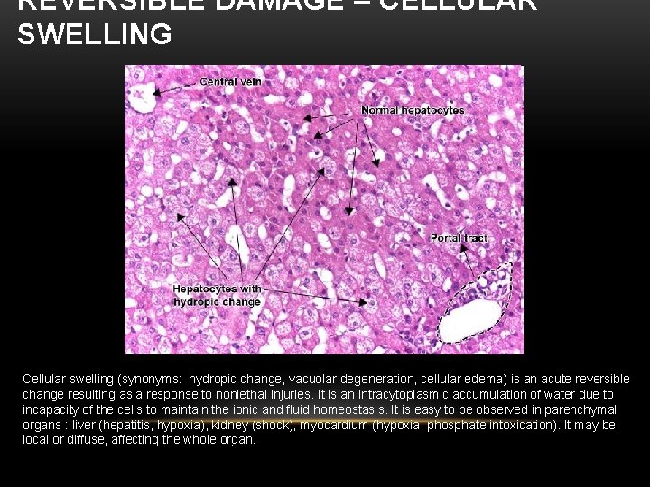 REVERSIBLE DAMAGE – CELLULAR SWELLING Cellular swelling (synonyms: hydropic change, vacuolar degeneration, cellular edema)