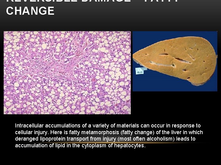REVERSIBLE DAMAGE – FATTY CHANGE Intracellular accumulations of a variety of materials can occur