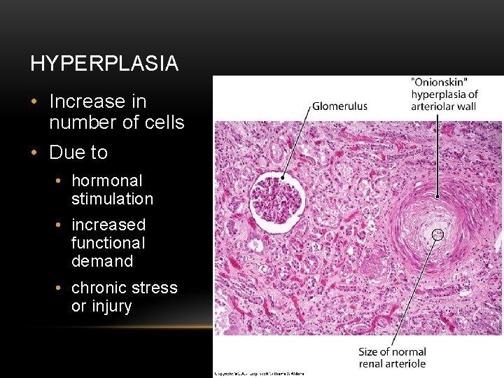 HYPERPLASIA • Increase in number of cells • Due to • hormonal stimulation •
