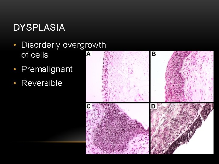 DYSPLASIA • Disorderly overgrowth of cells • Premalignant • Reversible 