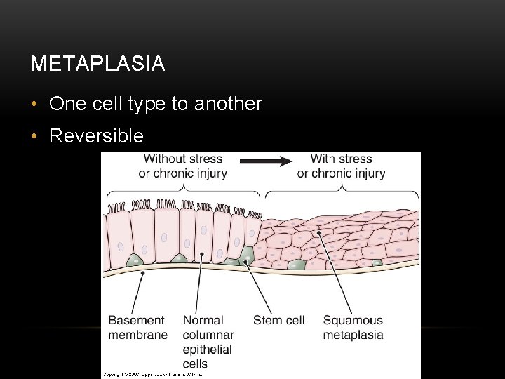 METAPLASIA • One cell type to another • Reversible 