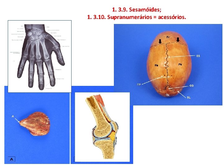 1. 3. 9. Sesamóides; 1. 3. 10. Supranumerários = acessórios. 