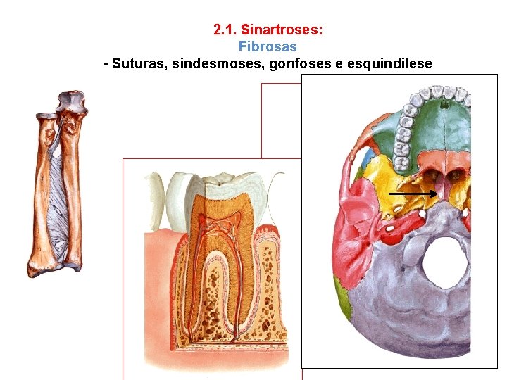 2. 1. Sinartroses: Fibrosas - Suturas, sindesmoses, gonfoses e esquindilese 