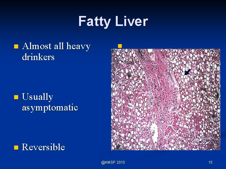 Fatty Liver n Almost all heavy drinkers n Usually asymptomatic n Reversible n @AMSP