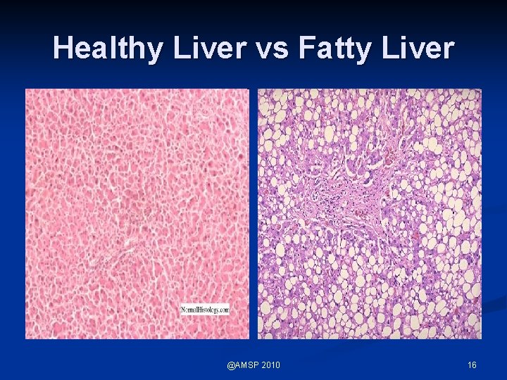 Healthy Liver vs Fatty Liver @AMSP 2010 16 