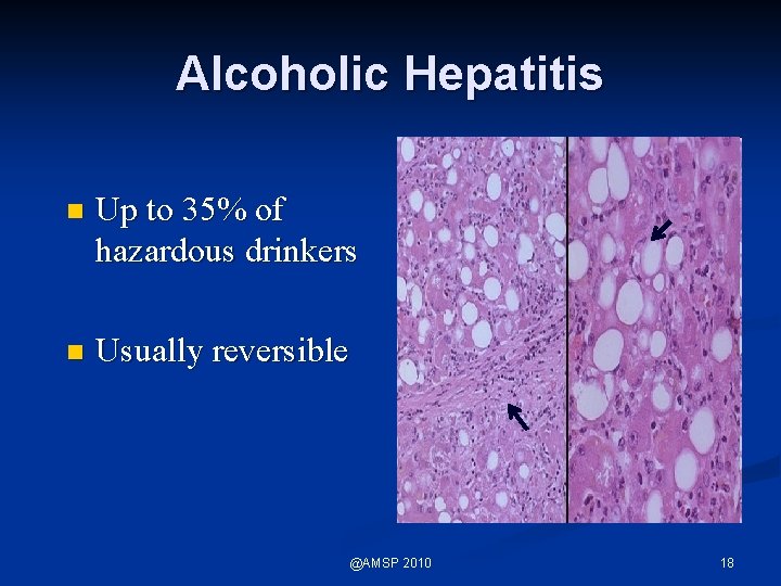 Alcoholic Hepatitis n Up to 35% of hazardous drinkers n Usually reversible @AMSP 2010