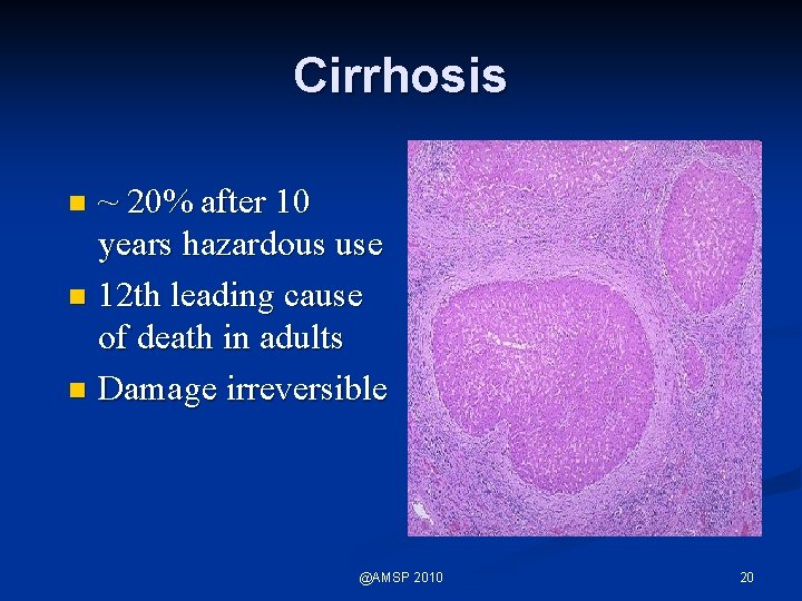 Cirrhosis ~ 20% after 10 years hazardous use n 12 th leading cause of