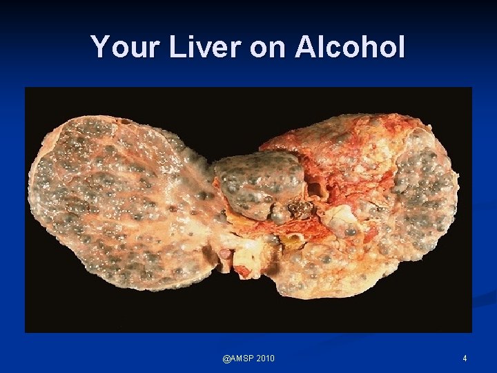 Your Liver on Alcohol @AMSP 2010 4 