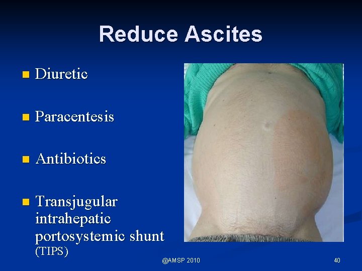 Reduce Ascites n Diuretic n Paracentesis n Antibiotics n Transjugular intrahepatic portosystemic shunt (TIPS)