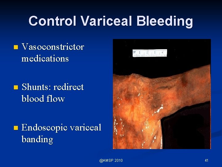 Control Variceal Bleeding n Vasoconstrictor medications n Shunts: redirect blood flow n Endoscopic variceal