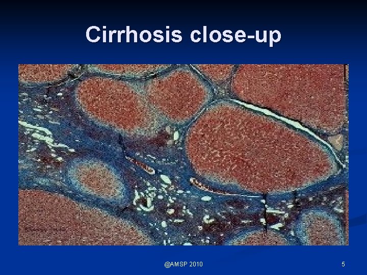 Cirrhosis close-up @AMSP 2010 5 