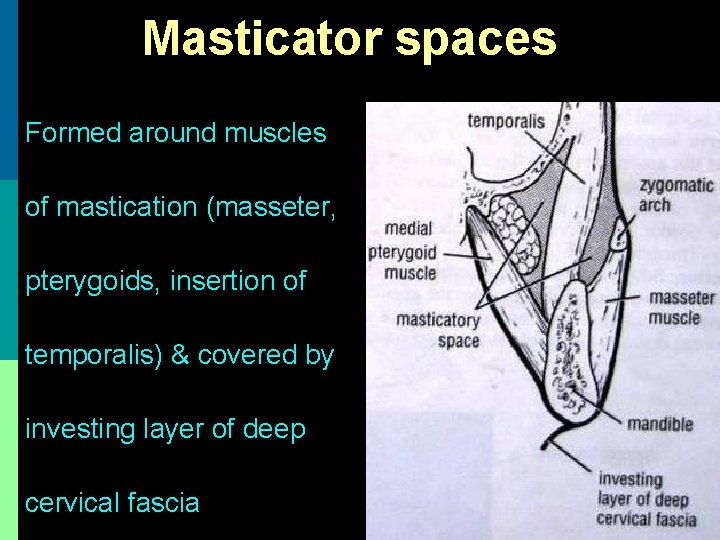 Masticator spaces Formed around muscles of mastication (masseter, pterygoids, insertion of temporalis) & covered