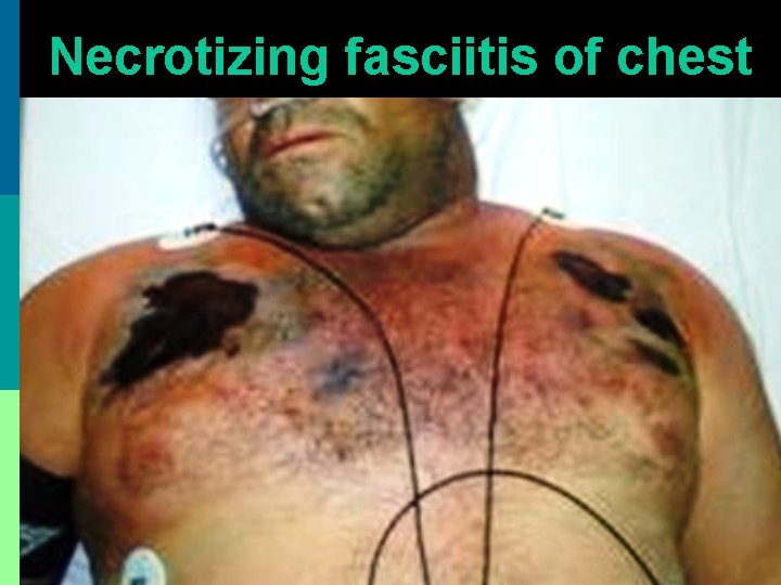 Necrotizing fasciitis of chest 