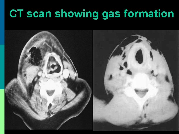 CT scan showing gas formation 