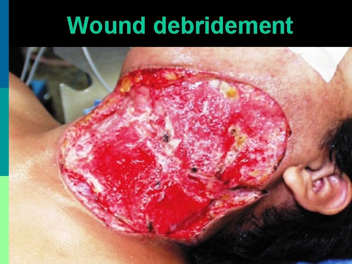 Wound debridement 