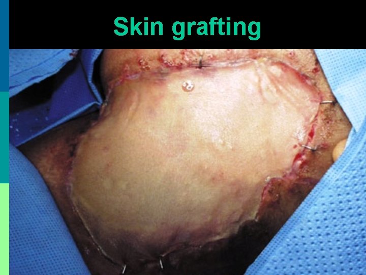 Skin grafting 