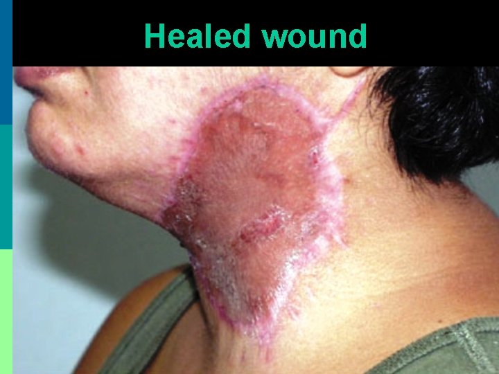 Healed wound 