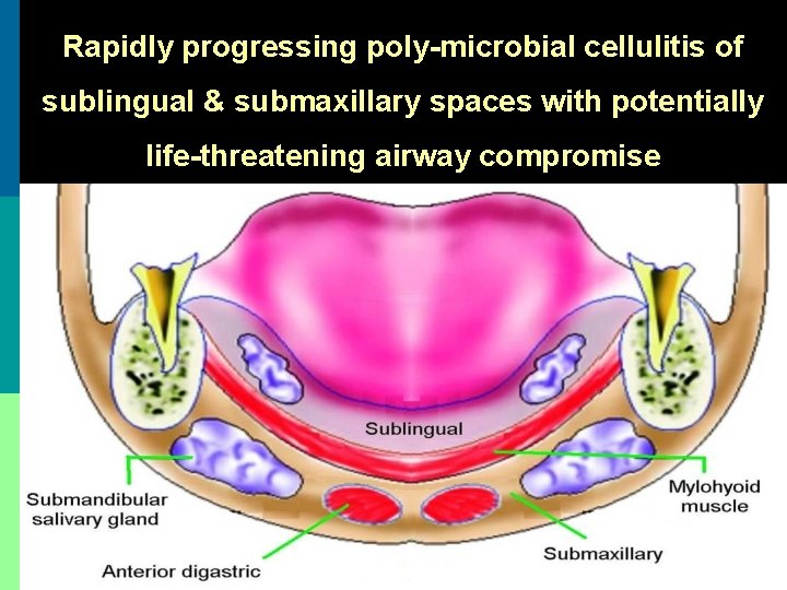 Rapidly progressing poly-microbial cellulitis of sublingual & submaxillary spaces with potentially life-threatening airway compromise