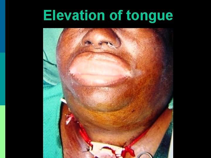 Elevation of tongue 