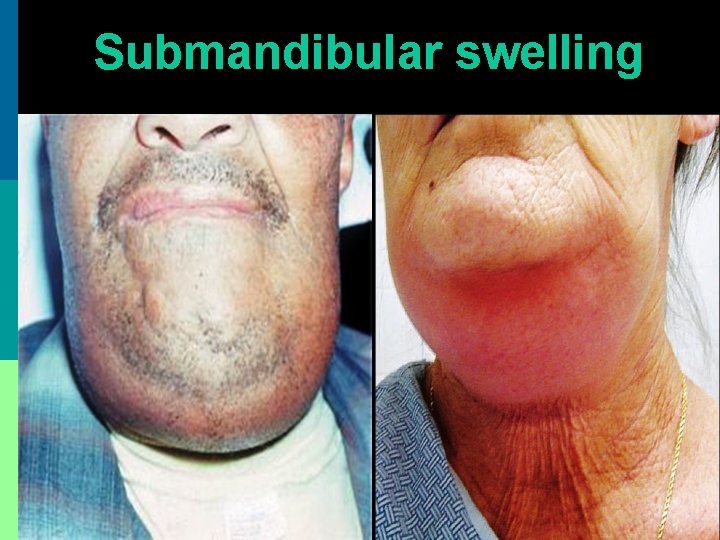 Submandibular swelling 