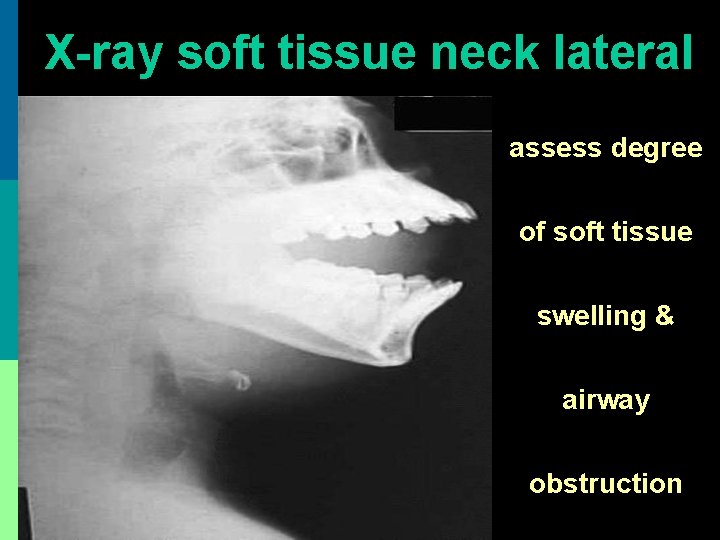 X-ray soft tissue neck lateral assess degree of soft tissue swelling & airway obstruction