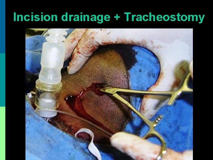 Incision drainage + Tracheostomy 