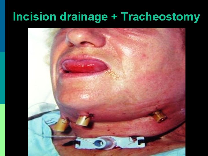 Incision drainage + Tracheostomy 