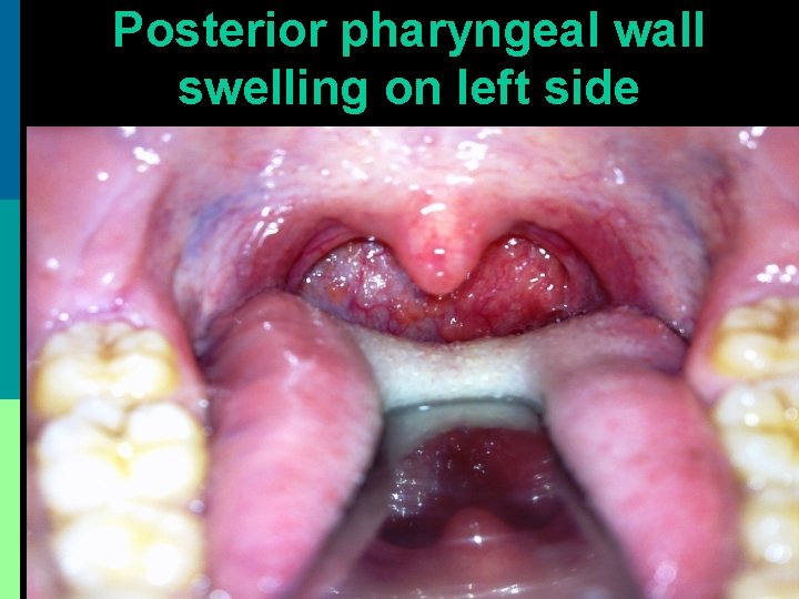 Posterior pharyngeal wall swelling on left side 