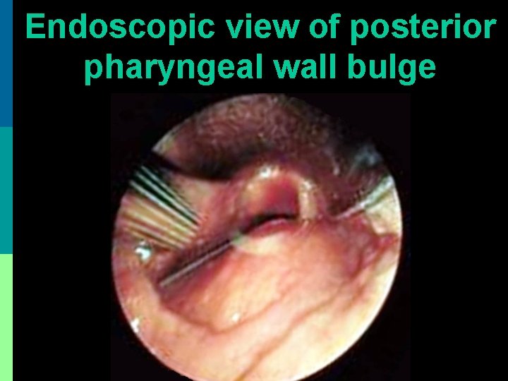 Endoscopic view of posterior pharyngeal wall bulge 