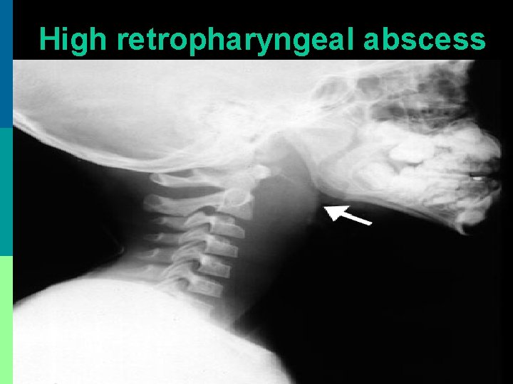 High retropharyngeal abscess 