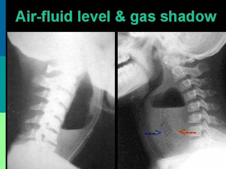 Air-fluid level & gas shadow 