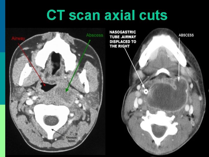 CT scan axial cuts 