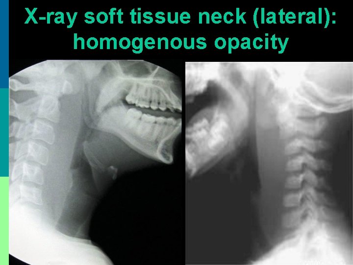 X-ray soft tissue neck (lateral): homogenous opacity 