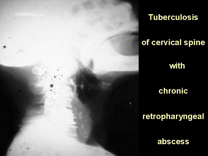 Tuberculosis of cervical spine with chronic retropharyngeal abscess 