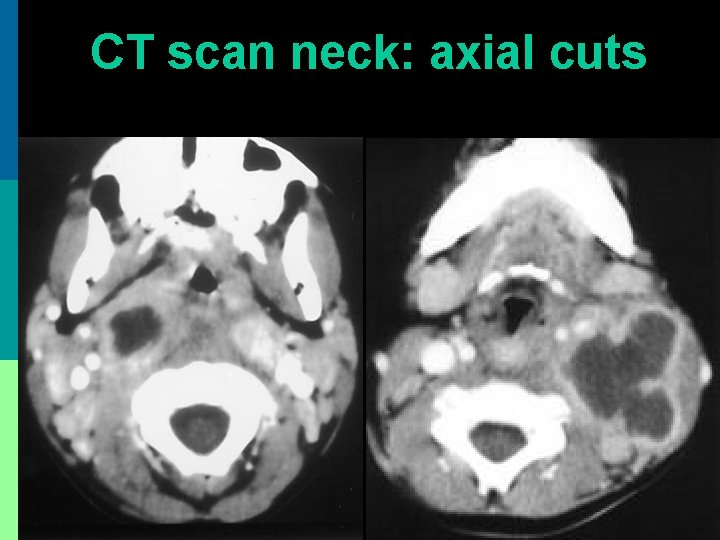 CT scan neck: axial cuts 