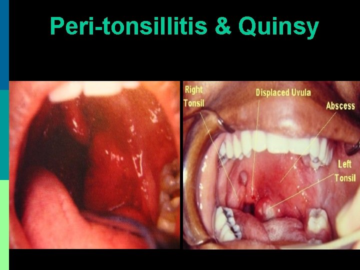 Peri-tonsillitis & Quinsy 