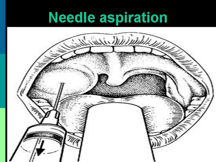 Needle aspiration 