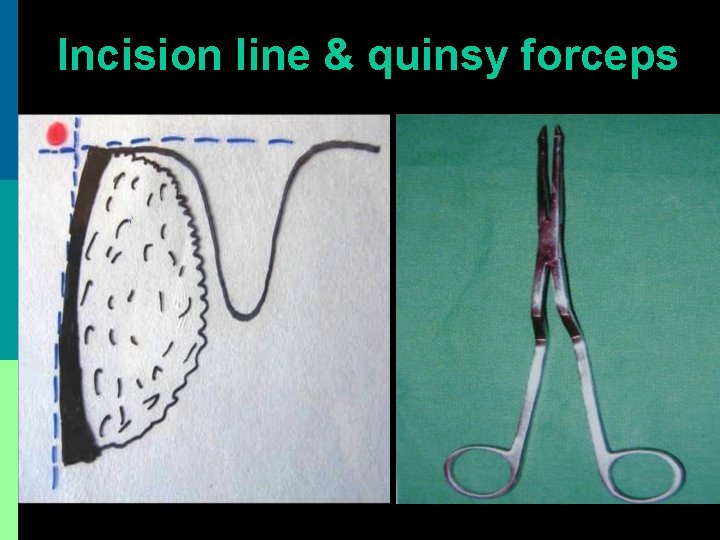 Incision line & quinsy forceps 