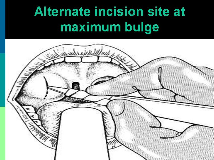 Alternate incision site at maximum bulge 