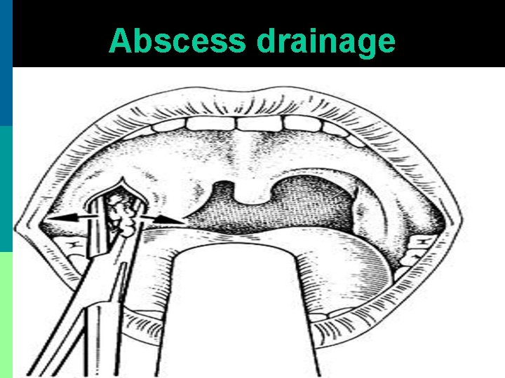 Abscess drainage 