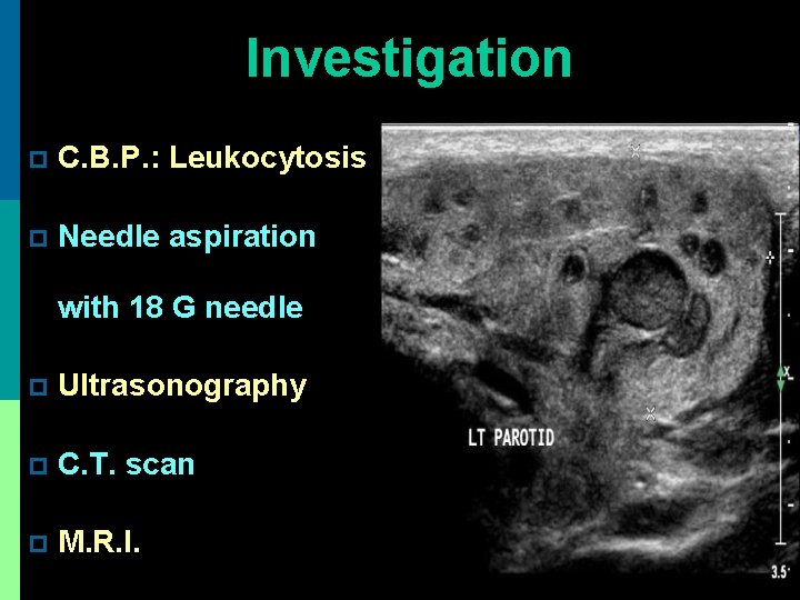 Investigation p C. B. P. : Leukocytosis p Needle aspiration with 18 G needle